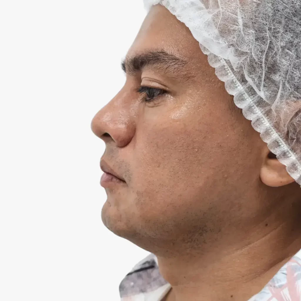 Cómo Bajar la Papada del Cuello en Hombres: Causas y Tratamientos Recomendados