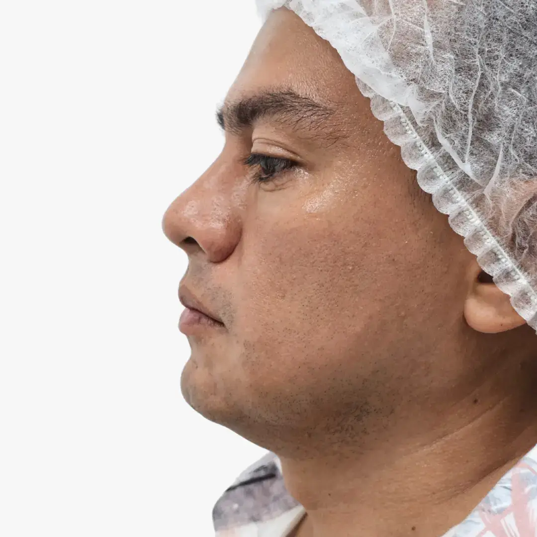 Cómo Bajar la Papada del Cuello en Hombres: Causas y Tratamientos Recomendados