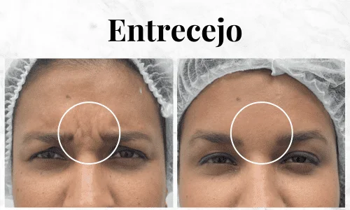 Cómo Eliminar el Entrecejo: Causas, Tratamientos y Consejos