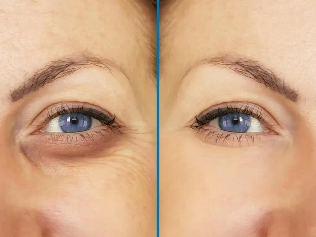 Ojeras Hundidas: Causas y Tratamientos en Lima