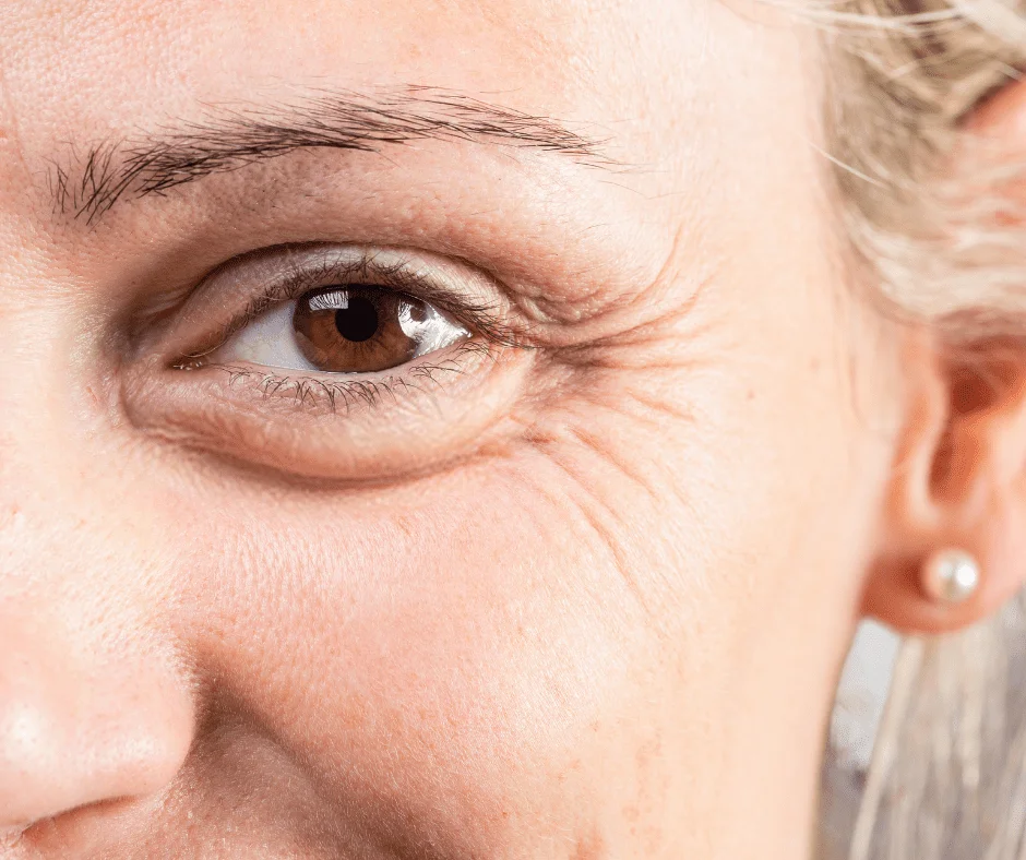 Toxina botulínica y Botox ¿Son lo mismo?