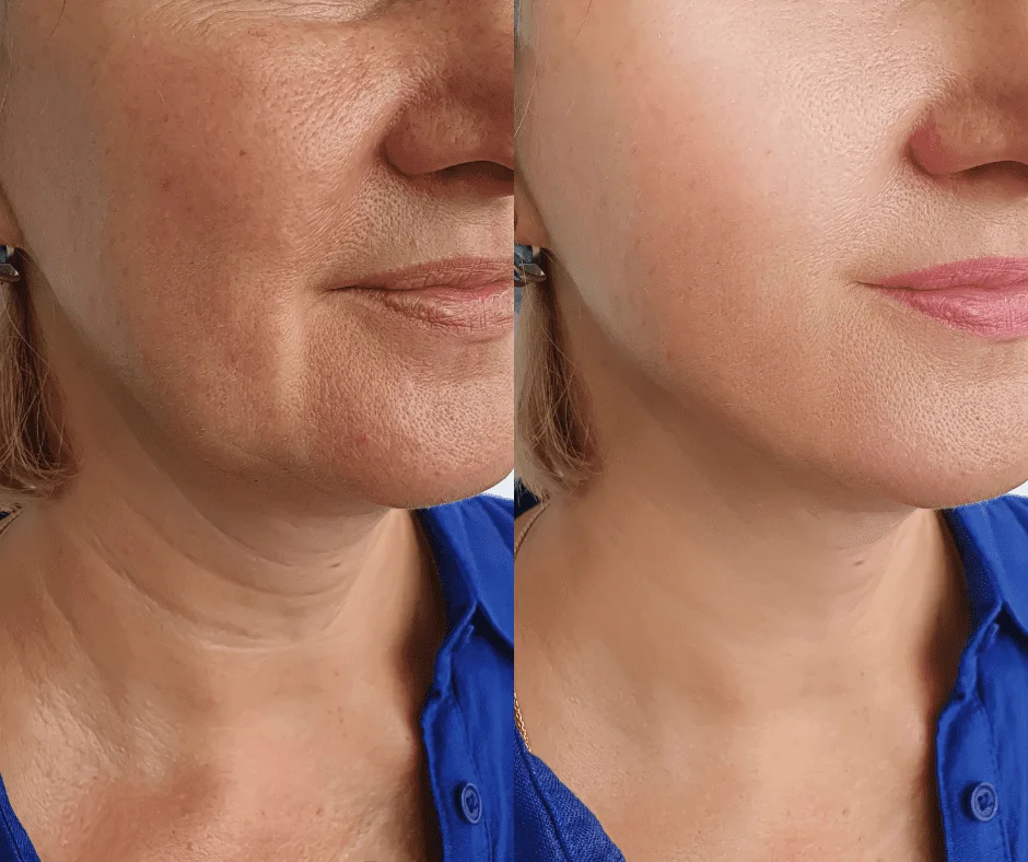 Lifting facial sin cirugía en Maryol