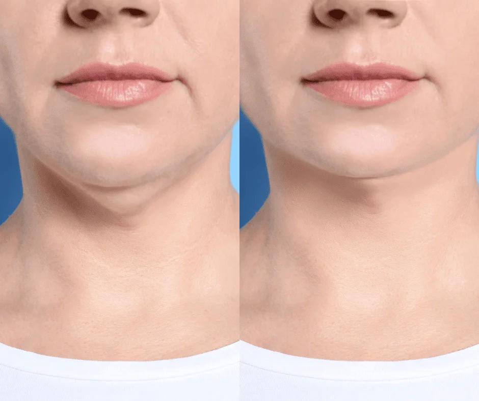 Lipopapada Antes y Después en Maryol Medicina Estética