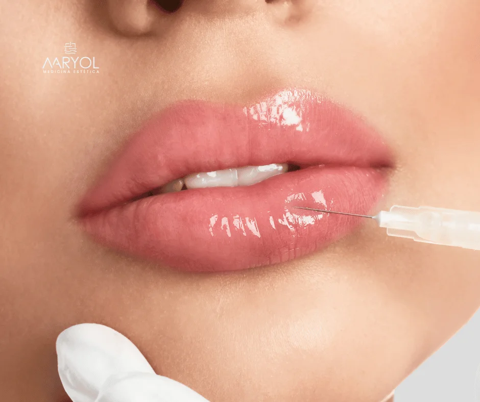 Relleno o aumento de labios con ácido hialurónico