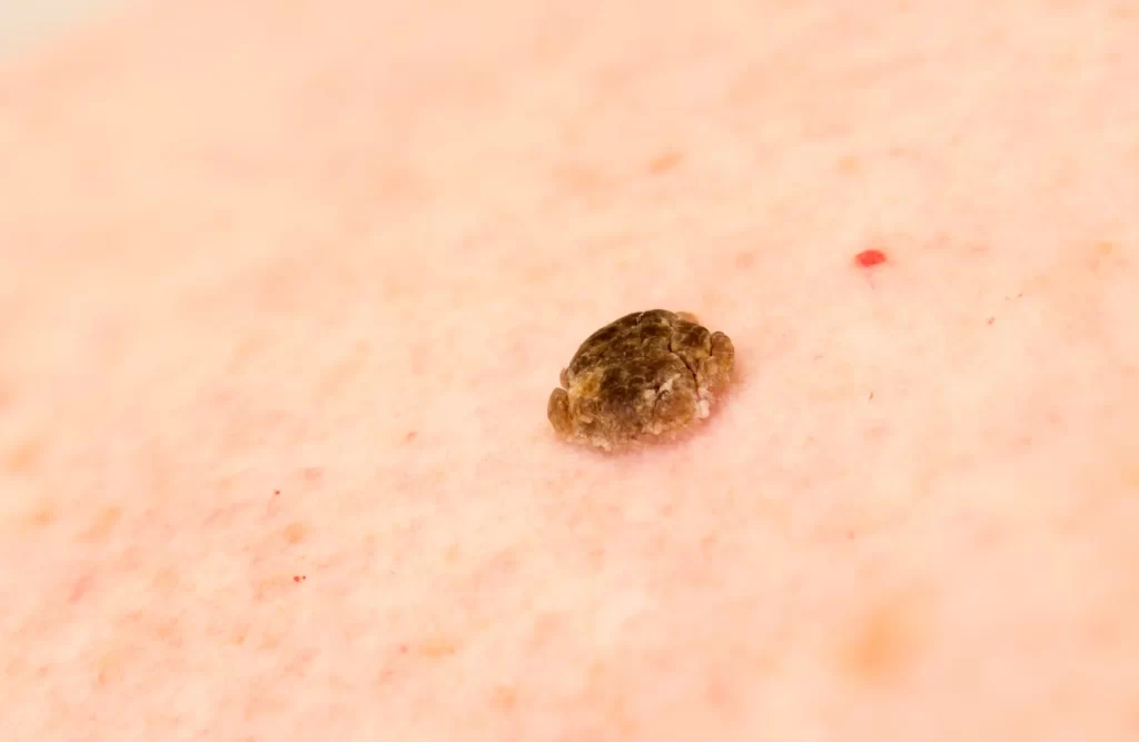 Elimina la Queratosis Seborreica de Forma Segura con Láser en Clínica Maryol