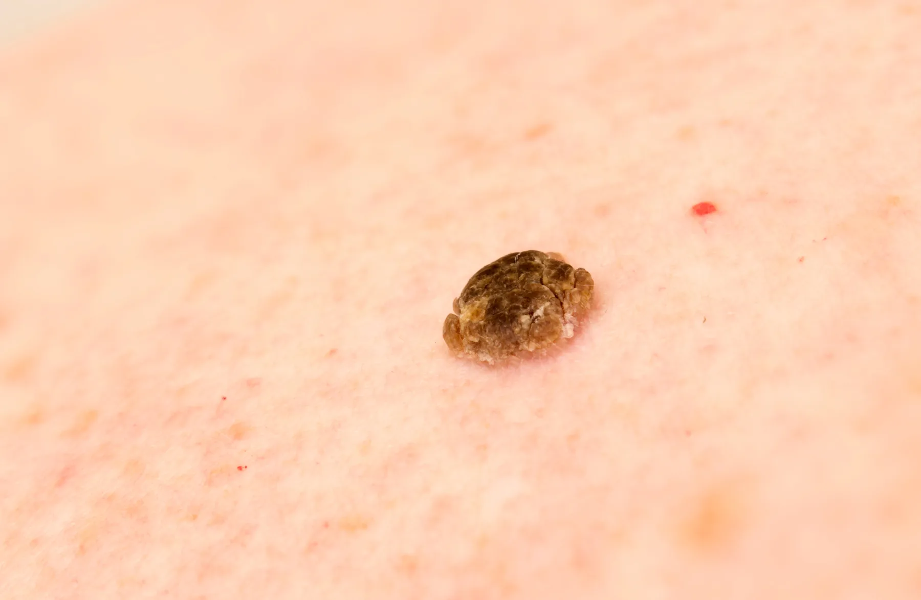 Elimina la Queratosis Seborreica de Forma Segura con Láser en Clínica Maryol