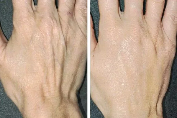 Rejuvenece tus manos sin cirugía: Ácido hialurónico y bioestimuladores en Lima