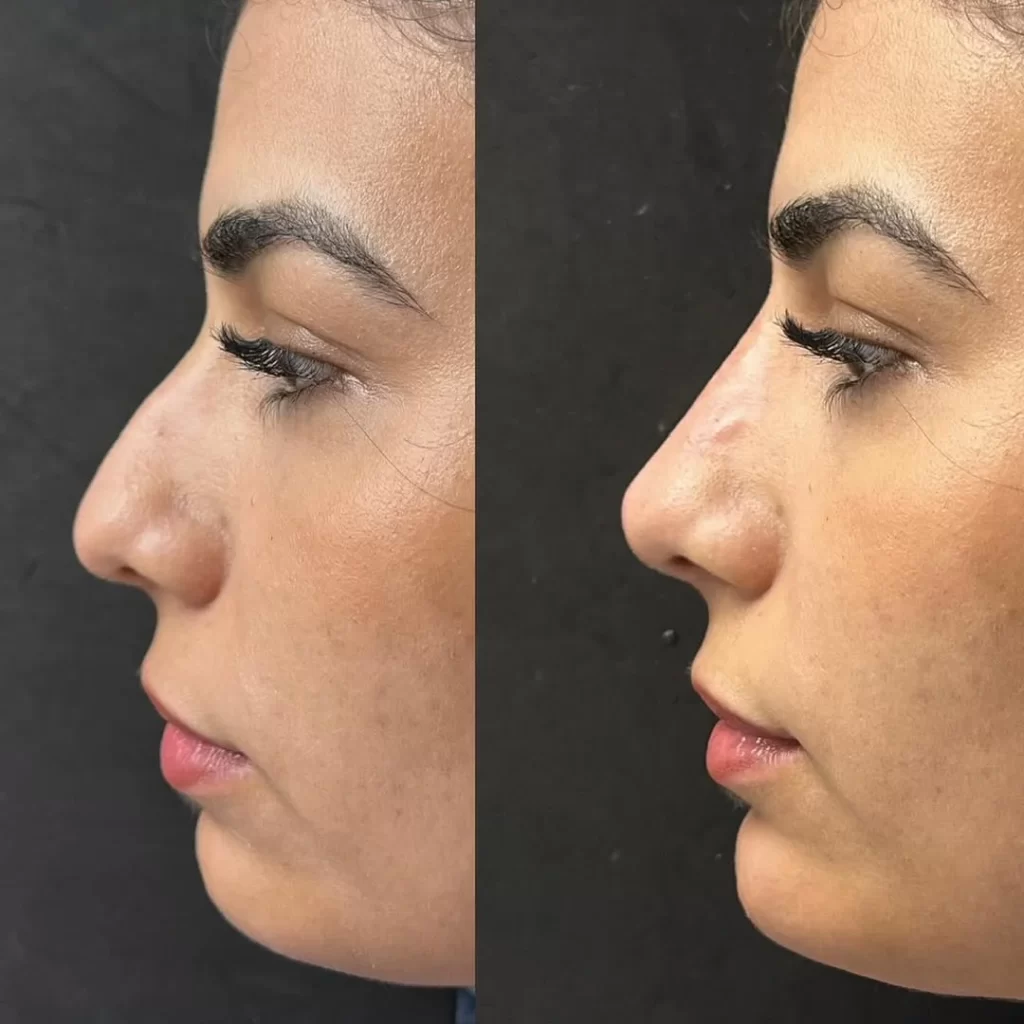 Perfila y corrige tu rostro sin cirugía: Ácido hialurónico y hilos tensores