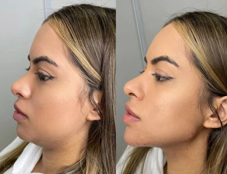 Mejora tu perfil y esculpe tus facciones: Armonización facial sin cirugía en Lima