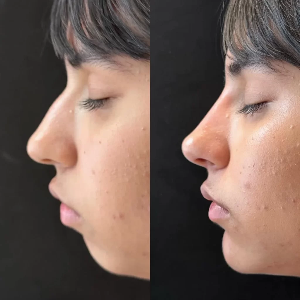Perfila y corrige tu rostro sin cirugía: Ácido hialurónico y hilos tensores