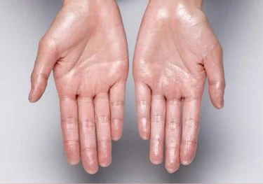 Tratamiento médico para hiperhidrosis con toxina botulínica