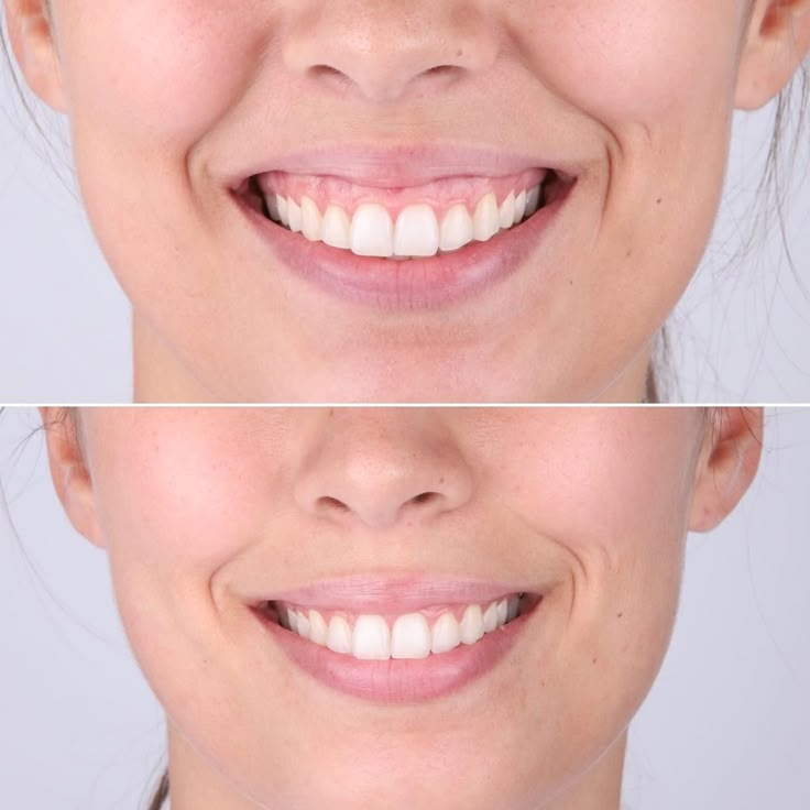 Corrige tu sonrisa gingival sin cirugía: armonía facial con toxina botulínica en Lima