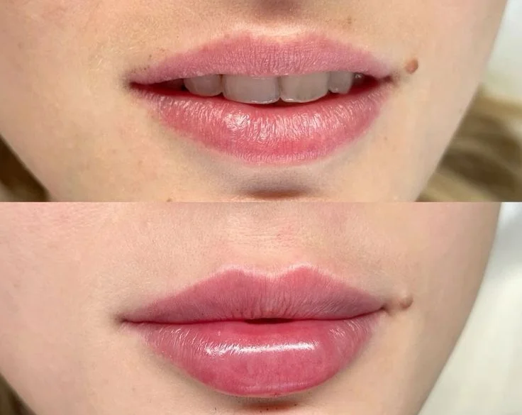 Aumenta el volumen y perfila tus labios con ácido hialurónico: Belleza natural sin cirugía