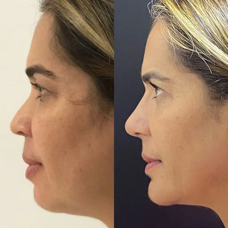 Perfila y corrige tu rostro sin cirugía: Ácido hialurónico y hilos tensores