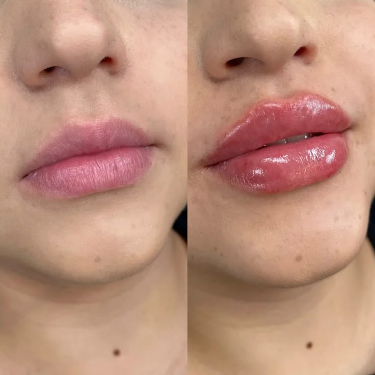 Aumenta el volumen y perfila tus labios con ácido hialurónico: Belleza natural sin cirugía