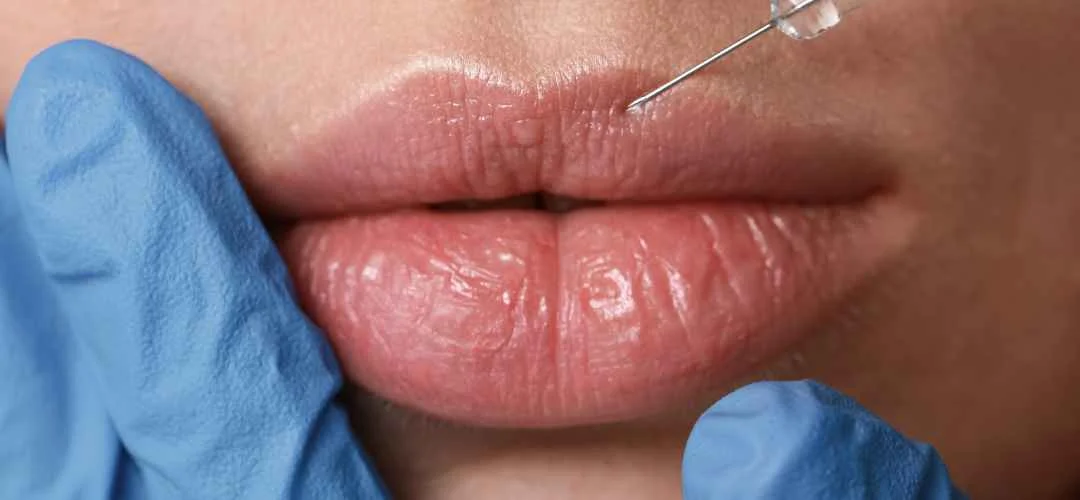 Beneficios del relleno de labios con ácido hialurónico