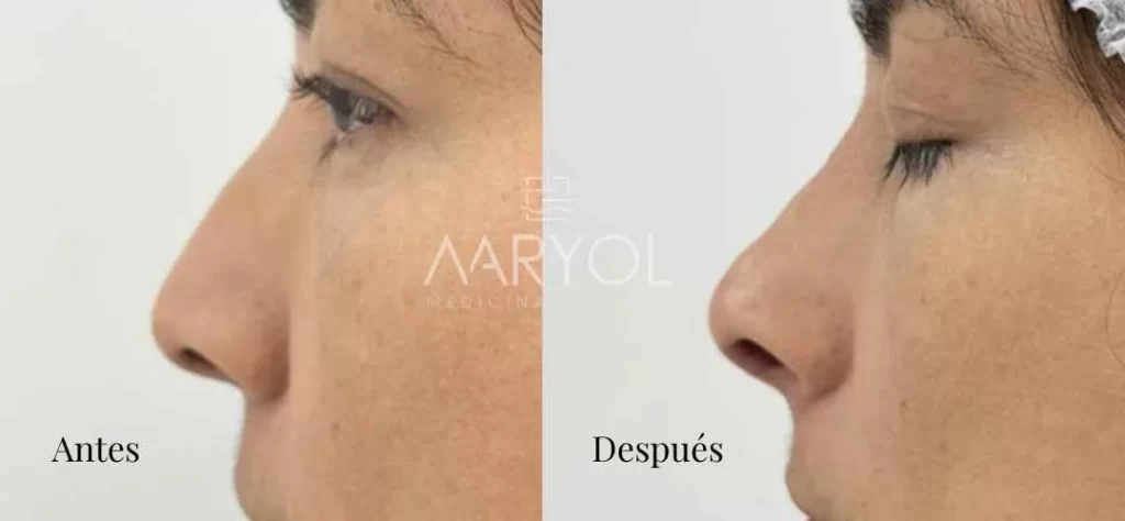 Rinomodelación con ácido hialurónico: antes y después de un perfil más armónico