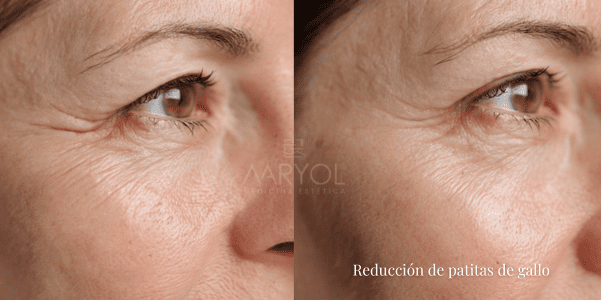 Usos de la toxina botulínica en estética facial: lo que sí hace y lo que no