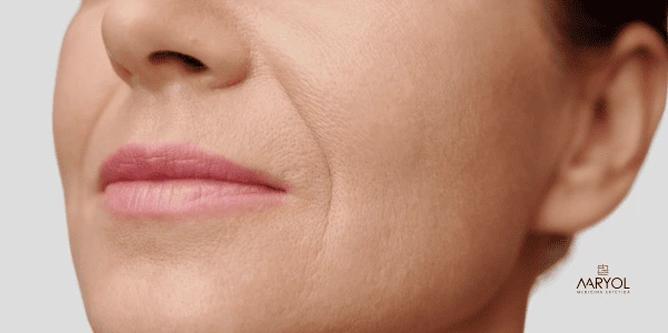 ¿Botox sirve para los surcos nasogenianos? La verdad médica