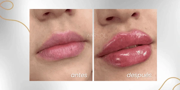Aumento de labios antes y después: resultados reales